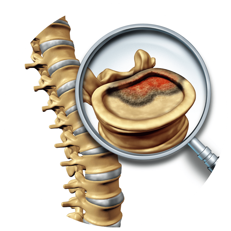 david stein heilpraktiker koblenz Bandscheibenvorfall