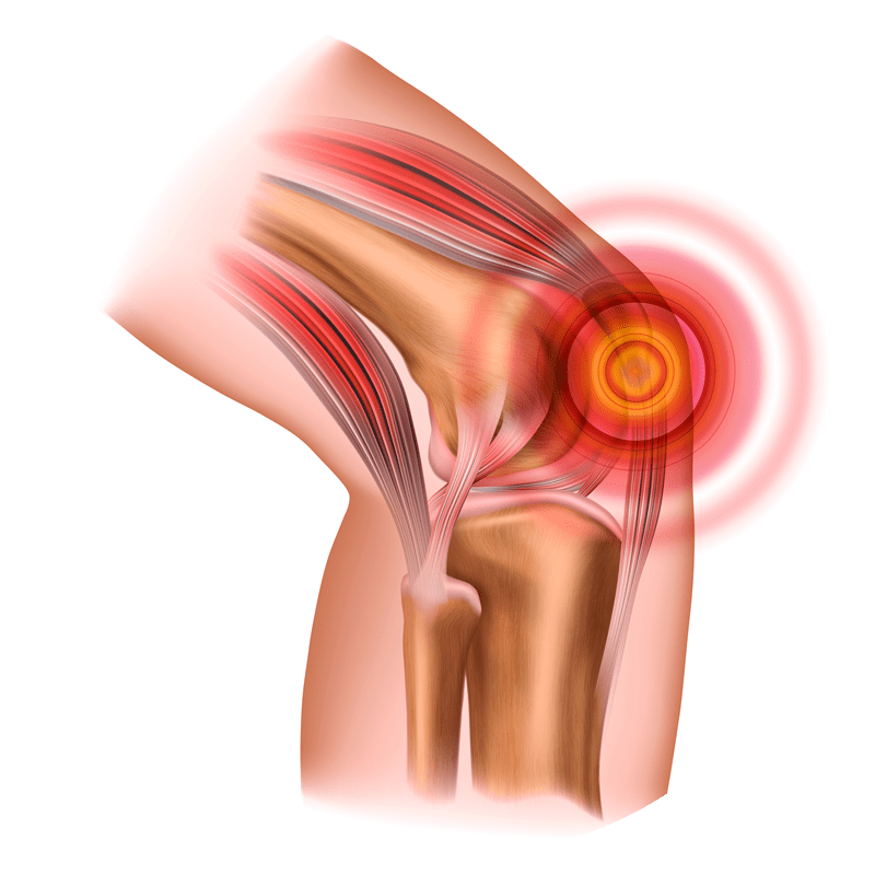 david stein heilpraktiker koblenz Patellasehnen Beschwerden